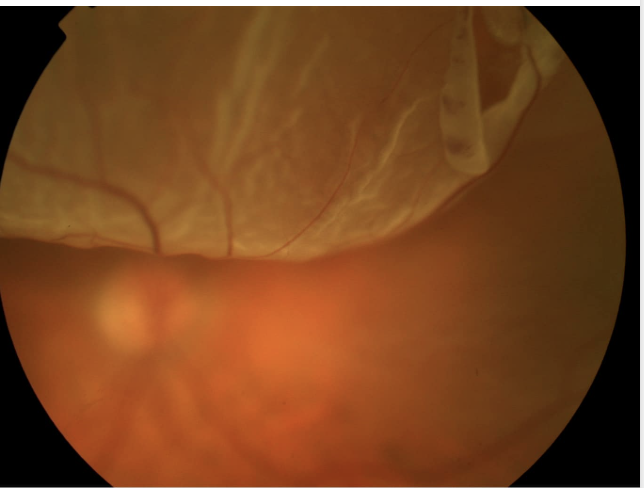 <p>56 y/o male presents to the ED for right vision loss, that came on “like someone was pulling the wool over my eye literally.” On physical exam you note some black things floating around on the red light reflex and the retina blowing in the wind on fundoscopic exam. What do you want to do</p>