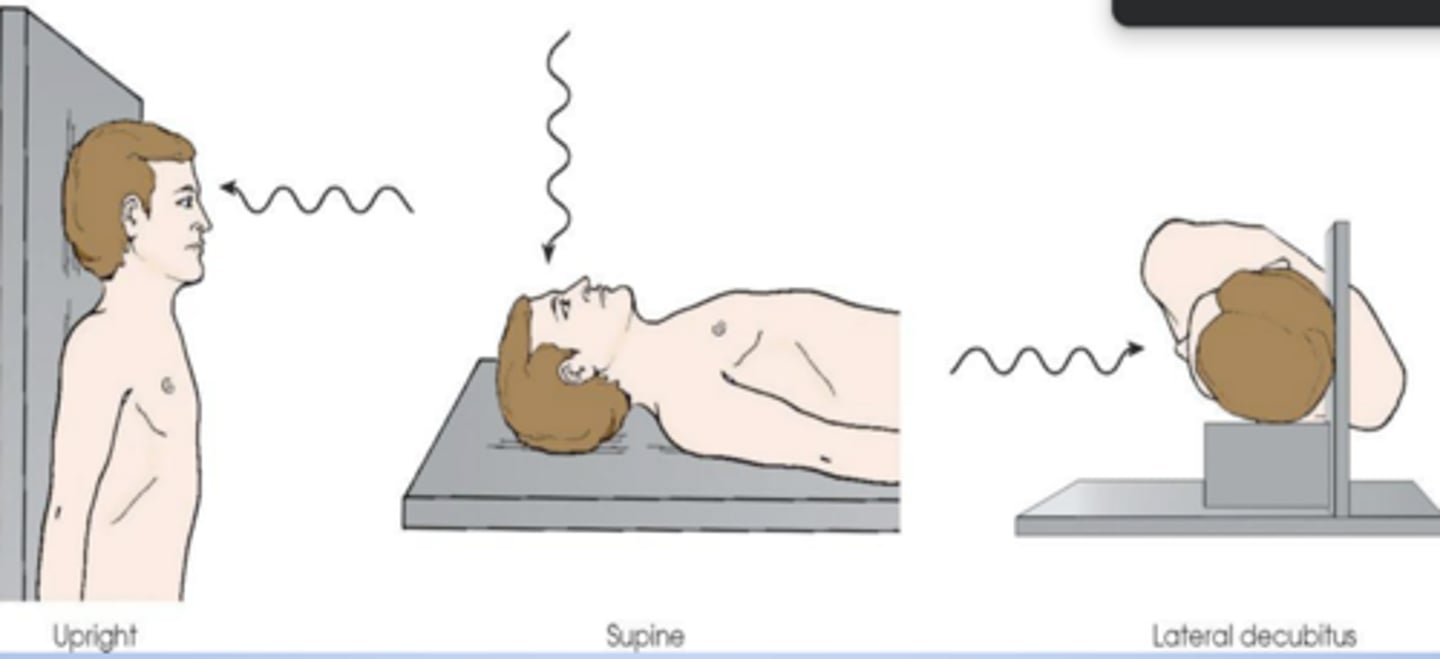 <p>Patient's head placed in upright, supine, and lateral decubitus positions for a radiograph. All three body positions produce:</p>