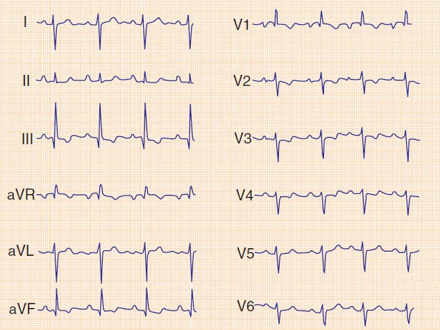 <p>PE  ECG Signs:</p>