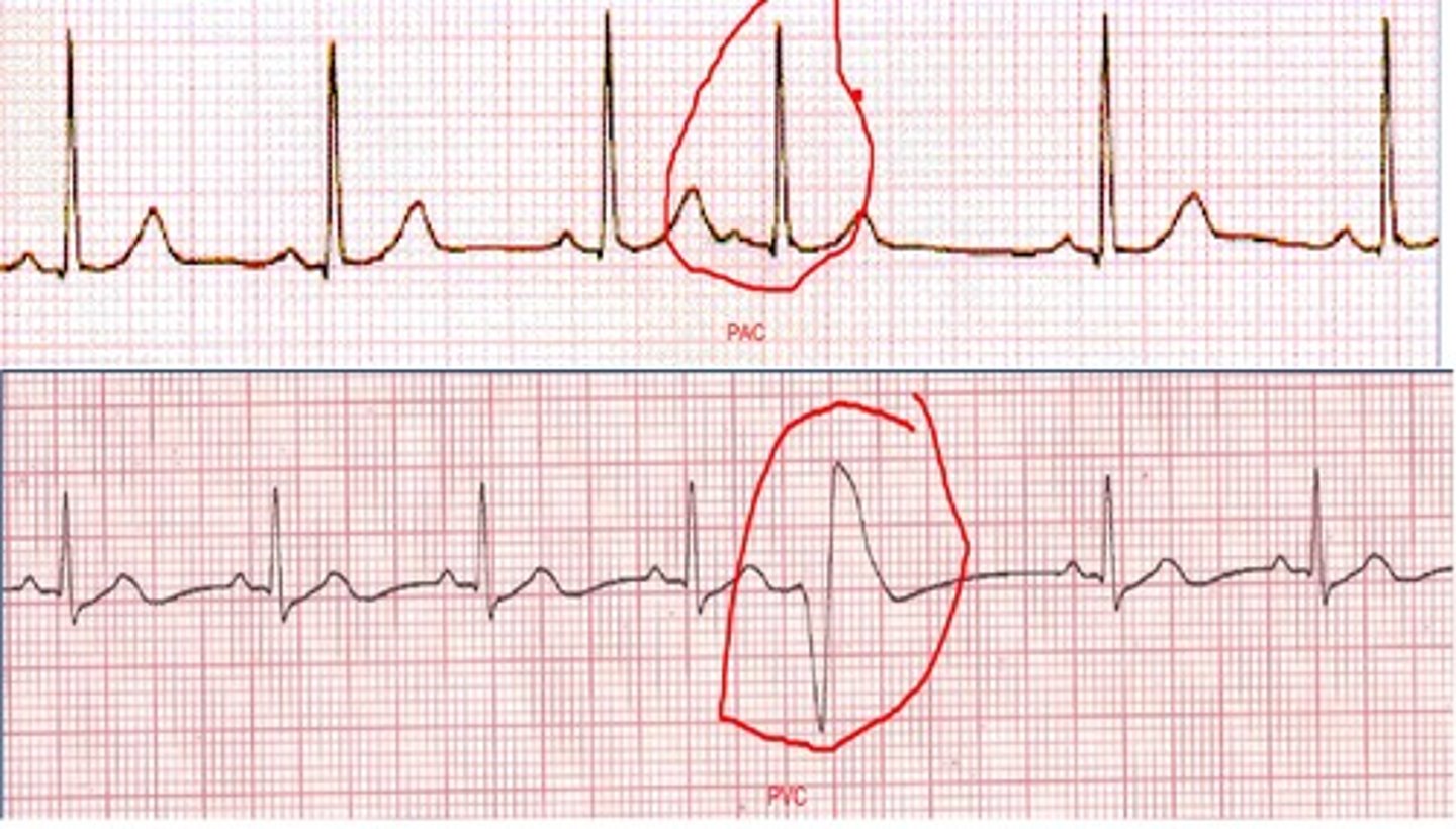 <p>Premature atrial/ventricular contraction</p><p>seen with tachy</p><p>-usually regular with caffeine</p><p>- treat if symptoms are present or &gt;6 a minute</p><p>-can turn into vtach</p>