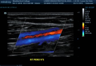 <ol><li><p>Where can we locate the peroneal veins?</p></li><li><p>Which appears more ‘posterior’ on US? PTVs or Peros?</p></li></ol><p></p>