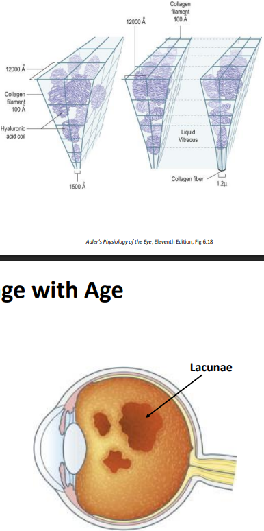 <p><strong>Liquefaction</strong></p><p>Infant vitreous: homogenous gel </p><p>With age, gel volume decreases &amp; liquid volume increases </p><ul><li><p><strong>40 yrs</strong>: <strong>80% gel/20% liquid </strong></p></li><li><p><strong>80 yrs</strong>: <strong>50% liquid</strong></p></li></ul><p>Exact molecular mechanism unclear </p><p>Hyaluronic acid is redistributed from the gel to the liquid</p><p><strong>Most liquefaction in cente</strong>r, where there is the<strong> least amount of collagen </strong></p><p><strong>Gel dissolves </strong>and is <strong>replaced with lacunae </strong></p><p><strong>Lacunae melt together over time</strong></p><p>Age-related vitreal changes are associated with age related ocular disease: </p><ul><li><p><strong>Nuclear sclerotic cataract </strong></p></li><li><p><strong>Diabetic retinopathy </strong></p></li></ul><p>Intact, normally composed vitreous provides “<strong>protection</strong>” </p><ul><li><p>Brings nutrients to ocular structures </p></li><li><p>Takes waste, metabolites, bad stuff away</p></li></ul><p></p>