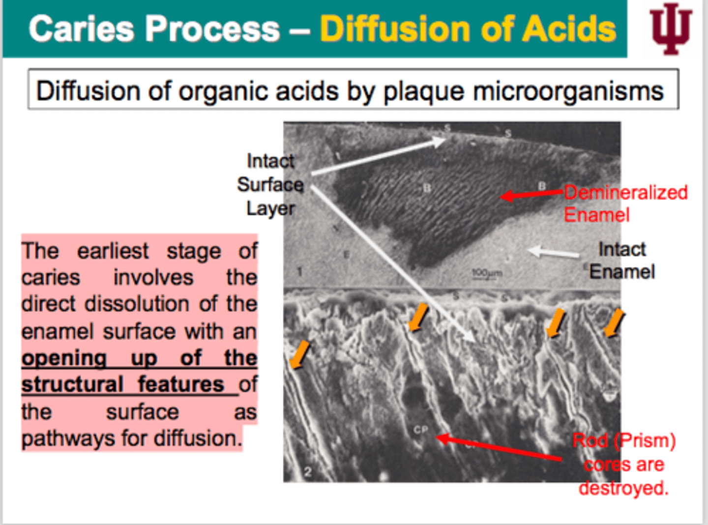 <p>This is the stage where you can certainly stop the carious process and you can maintain the current structure of your mouth.</p>