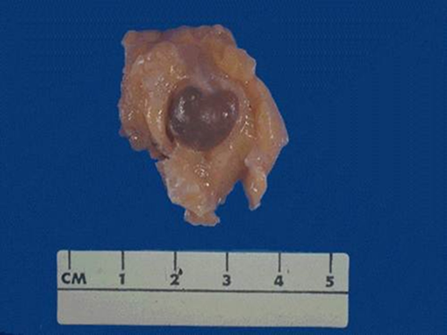 <p>Most common of the two types</p><p>- Formation of cysts</p><p>- Increase in fibrous stroma</p><p>- No epithelial hyperplasia</p><p>Cysts range from &lt;1cm to 5cm</p><p>They are typically blue -&gt; "blue dome cysts"</p>