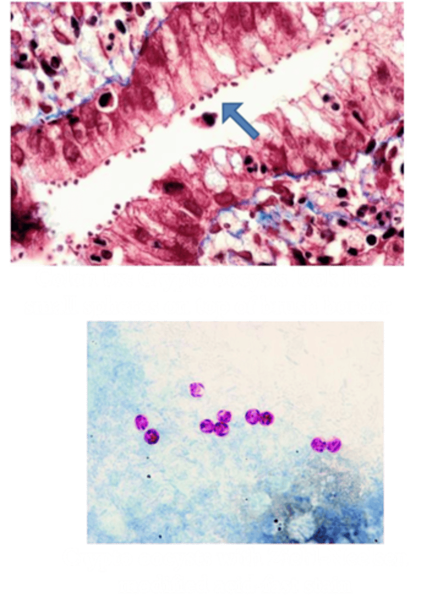 <p>Identify Pathogen causing Diarrhea:</p><p>-Hx:</p><p>&gt; Fecal-Oral Transmission (cysts in stool --&gt; contaminate water)</p><p>&gt; Oocysts in water --&gt; Infex (MC in Swimming pools - chloride doesn't destroy)</p><p>-Path: Protozoae forms eggs (oocysts)</p><p>-Sx/PE:</p><p>&gt; Immunocompetent = Mild, Watery Diarrhea</p><p>&gt; HIV/ADS = SEVERE DIARRHEA</p><p>-Dx:</p><p>&gt; Stool: Spheres atop brush border via acid-fast staining, or direct fluorescent Ab (DFA1)</p><p>&gt; ELISA = Antigens</p><p>&gt; PCR</p><p>-Prog:</p><p>&gt; Immunocompetent = SELF LIMITED</p>