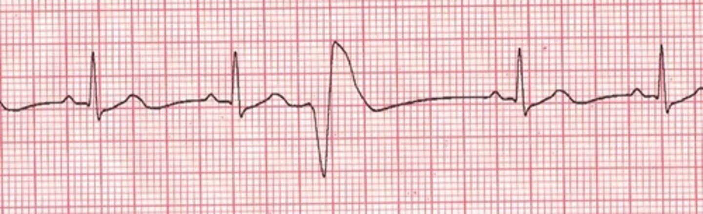 <p>Irritable focus in the ventricles fires prematurely to produce a single ectopic beat</p><p>QRS findings are wide</p><p>couplet (every other) or trigeminy (every third)</p>