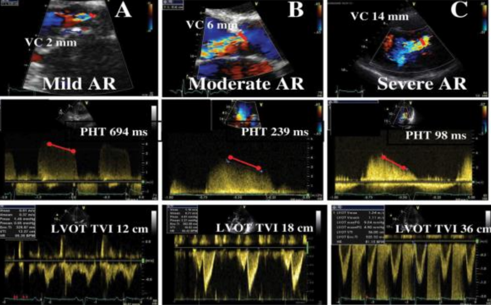 <p>Done the same way it is used to calculate MS, however, the only difference is that the steeper the waveform the more severe the AR.</p>