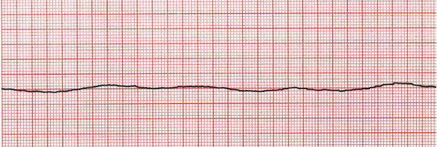 <p>Rhythm that has no electrical activity, use CPR</p>