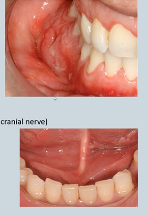 <ul><li><p>Oral Manifestations - might be the first signs </p><ul><li><p>Lip swelling - bilateral </p></li><li><p>Deep linear sulcal ulceration- top </p></li><li><p>Stag-horning - bottom</p></li><li><p>Cobble stoning of the buccal mucosa </p></li><li><p>Glossitis due to secondary malabsorption </p></li></ul></li><li><p>Melkersson-Rosenthal syndrome – facial nerve paralysis (7th cranial nerve)</p></li></ul><p></p>