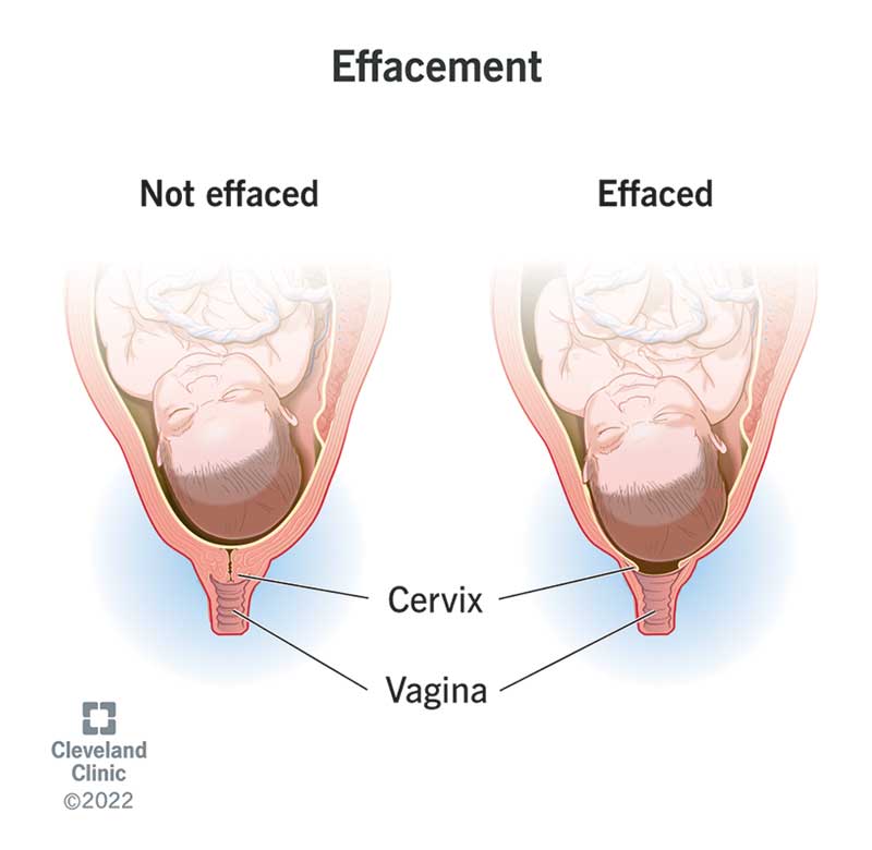 <p>the cervix stretches and gets thinner</p>