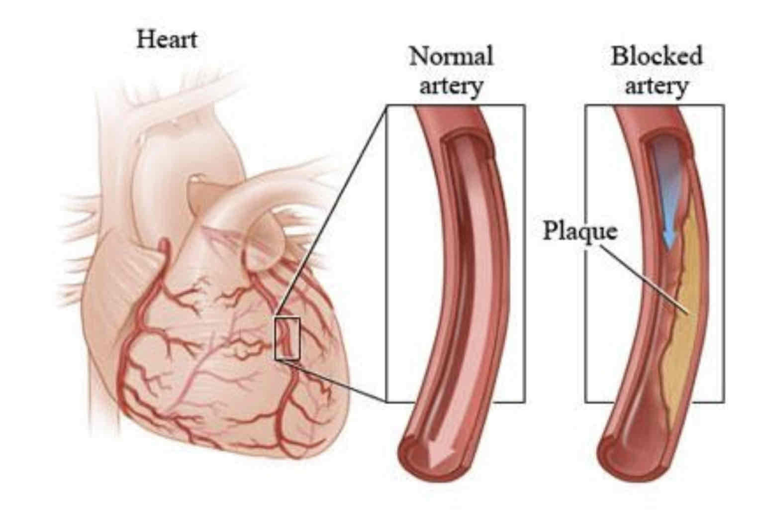 <p>The inner wall of the artery has a smooth <strong>endothelial</strong> lining. Atheroma is deposited on the endothelium, reducing the available volume for blood flow. The atheroma may completely block the artery’s lumen.</p>