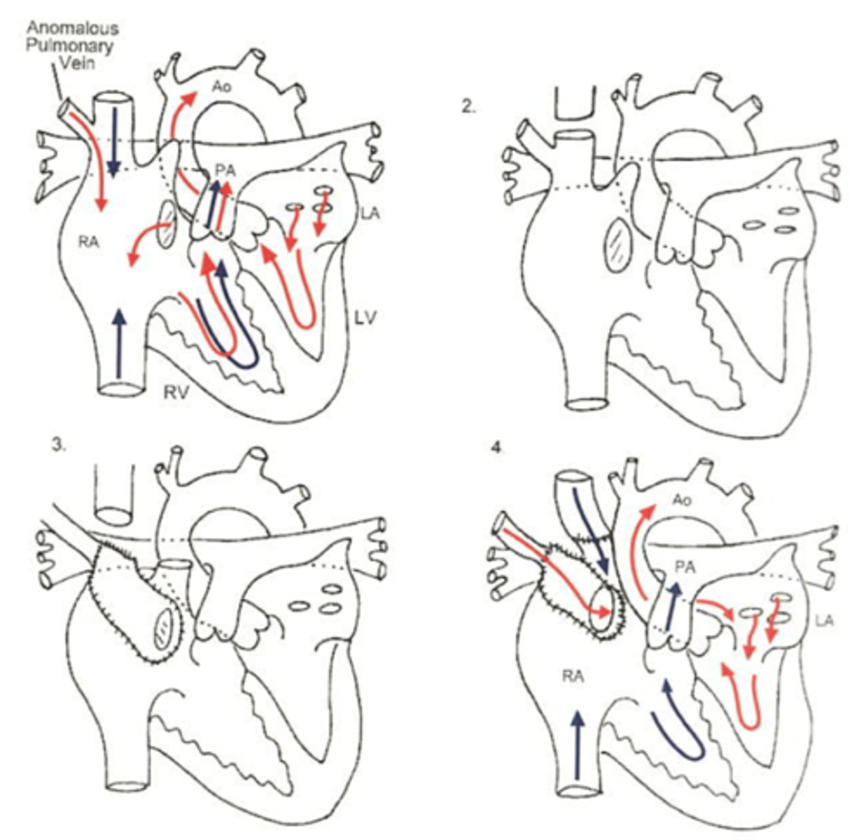 <p>Warden procedure if >2 cm from the SVC/RA junction or above the azygous junction: cut SVC cephalic and taking inferior portion and suturing to pulmonary veins and superior portion and suturing directly to right atrial appendage. </p><p>Otherwise, baffle directing flow from pulmonary veins into left atrium while directing flow from SVC into right atrium. If done with a two patch repair: one patch directing flow and other patch keeping SVC from getting stenosed. This second patch has risk for SA node interruption when suturing.</p>