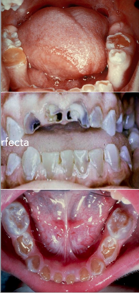 <ul><li><p>Blue/grey translucent (opalescent teeth)</p></li><li><p><strong>Different mutation</strong> to dentinogensis imperfecta</p></li><li><p>Both dentitions affected</p></li><li><p><strong>Obliterated pulp chamber/ shell teeth</strong></p></li><li><p>Fracture of enamel and dentin</p></li><li><p>Open bite, cross bite</p></li><li><p>Vertical dimension decrease</p></li></ul><p></p>