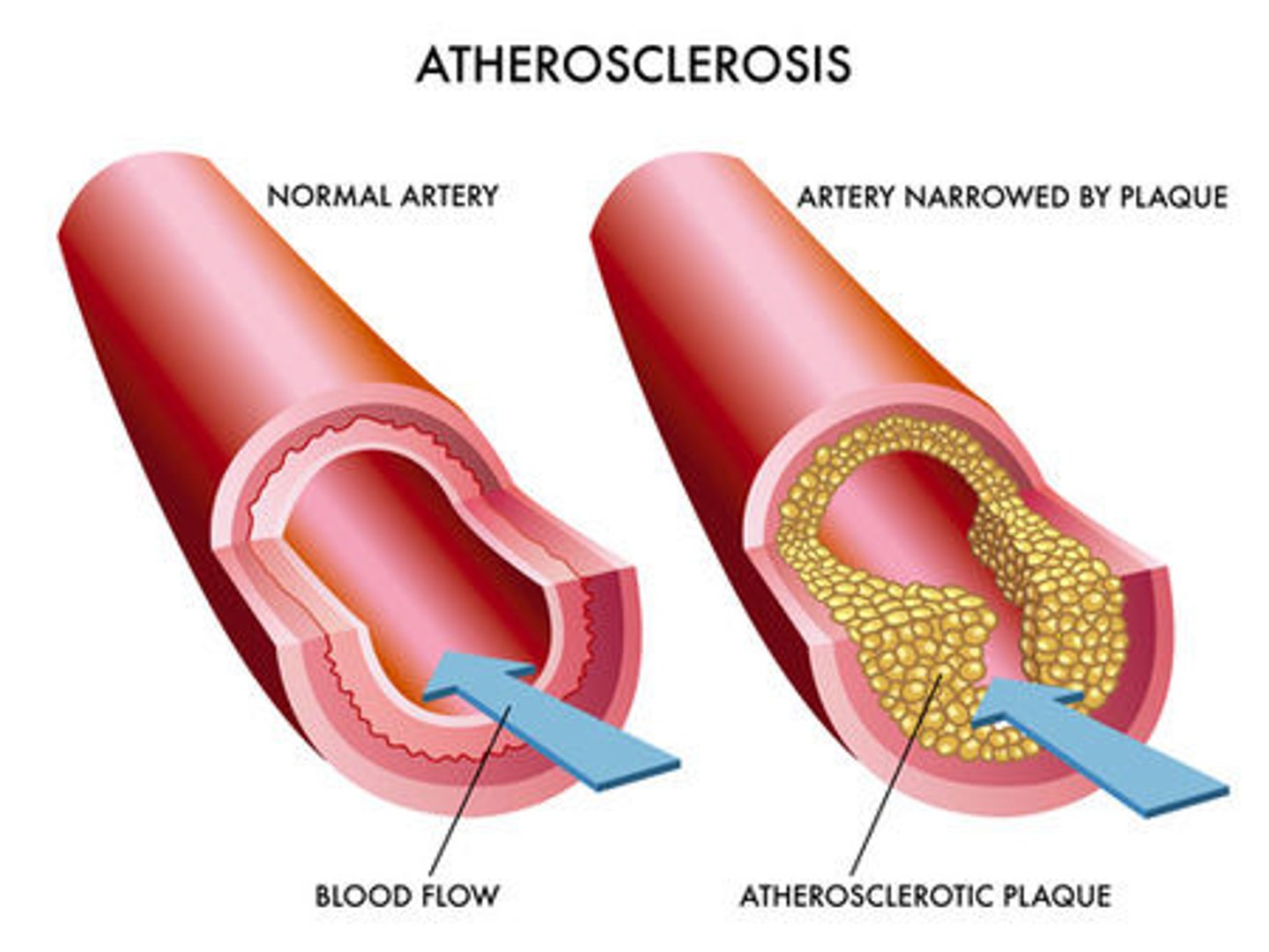 <p>An artery disease caused by plaque buildup in the wall of the arteries that supple blood to the heart. Plaque buildup causes the inside of the arteries to narrow over time and cuts off the supple of blood and oxygen to the heart muscle.</p><p>When the coronary arteries narrow, the heart needs to pump faster to force more blood through</p>