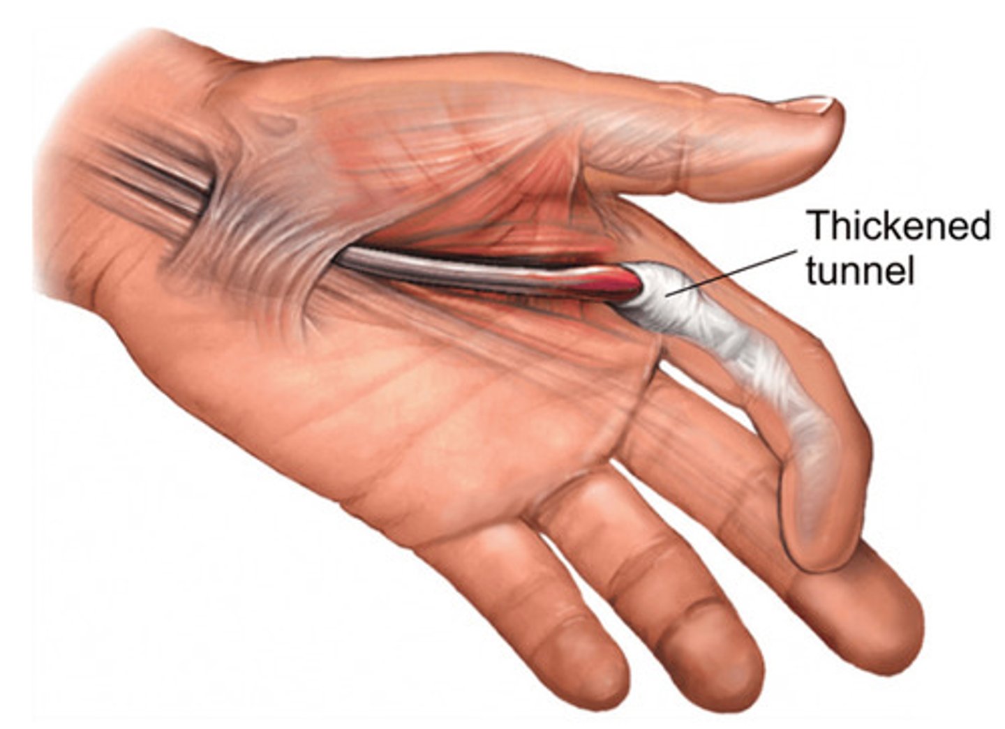 <p>A condition whereby the finger flexors contract but are unable to reextend because of a nodule within the tendon sheath or due to the sheath being too constricted to allow for free motion.</p>