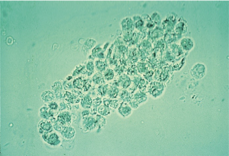 <p>WBC cast</p>