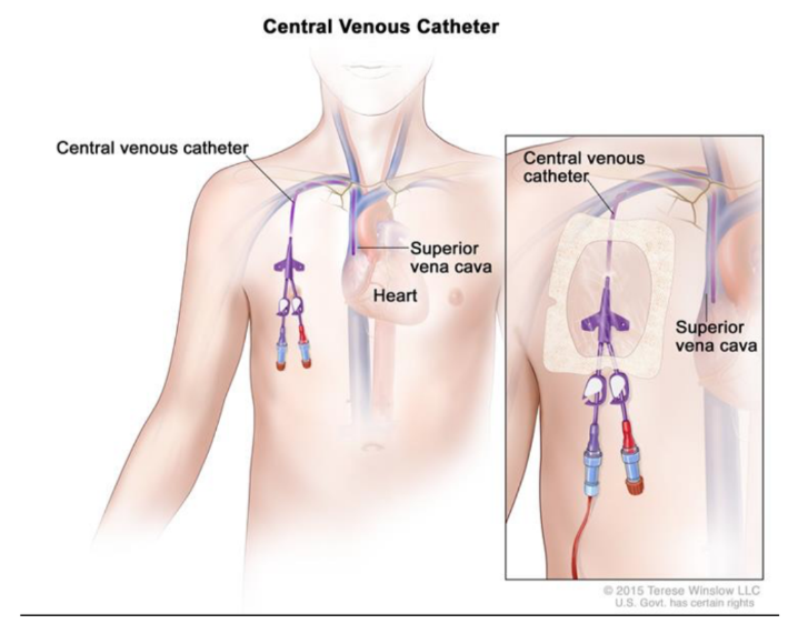 <ul><li><p>Large systematic veins are used to establish central venous access for administering large amounts of fluid, drugs, and blood</p></li><li><p>Most of these lines (small-bore tubes) are introduced through venous puncture into the axillary, subclavian, or internal jugular veins</p></li><li><p>The lines are then passed through the main veins of the superior mediastinum, with the tips of the lines usually residing in the distal portion of the superior vena cava or in the right atrium</p></li></ul>