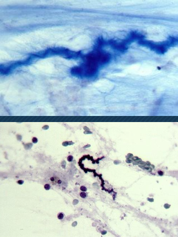 <p>Espirales de Curschmann</p><p></p>