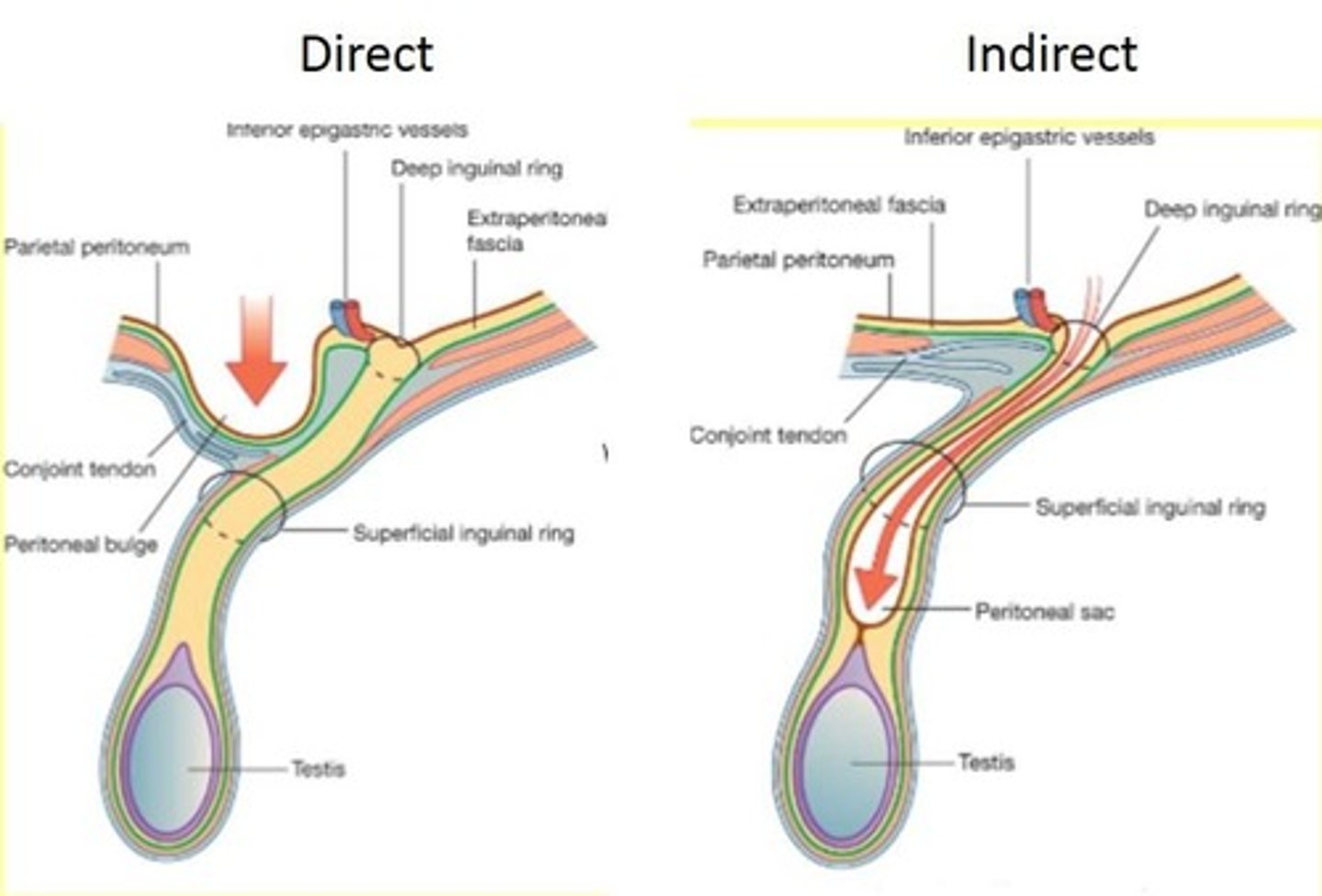 <p>Direct Inguinal</p>