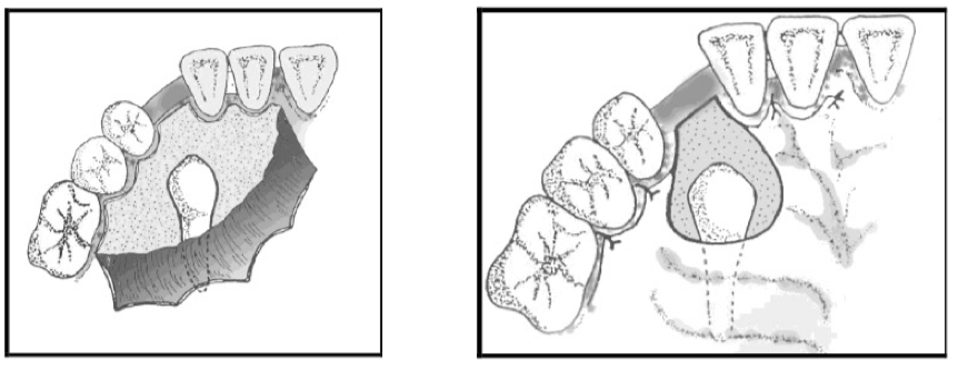 <p>Buccal canines- similar to conductive alveolotomy, but flap is repositioned apically, suturing the attached gingiva around the neck&nbsp;</p><p>Palatal- remove mucosa to expose canine&nbsp;</p>