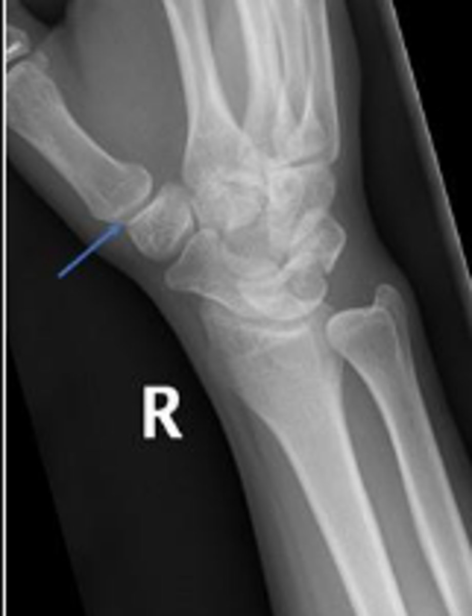 <p>What joint space is the arrow pointing to?</p>