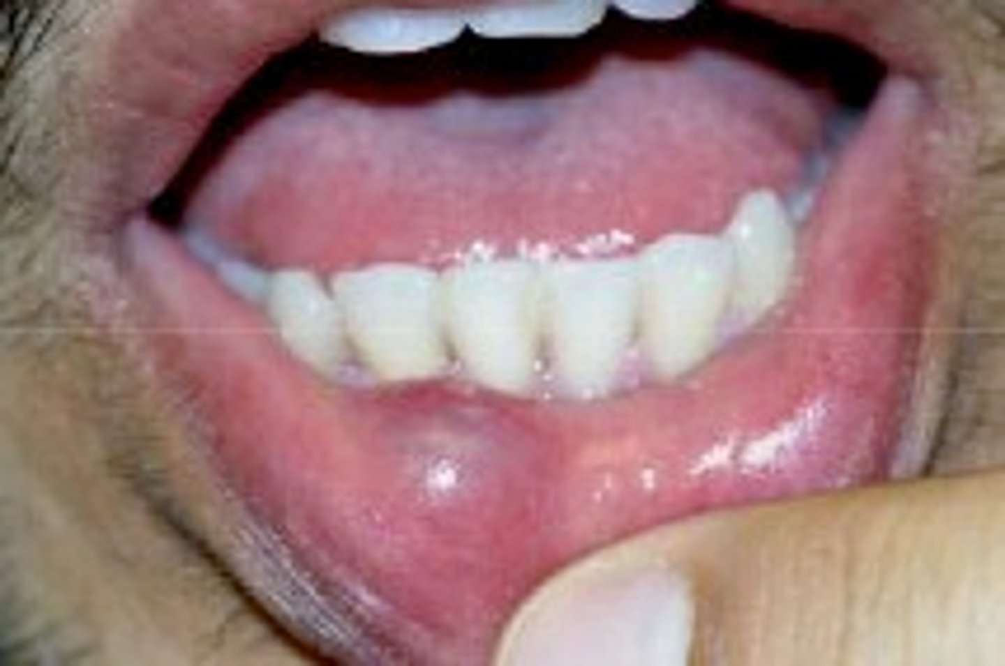 <p>Lower lip most common site</p><p>Bluish/pink fluid filled nodule</p><p>Caused by traumatic severance of salivary gland ductRanula</p>