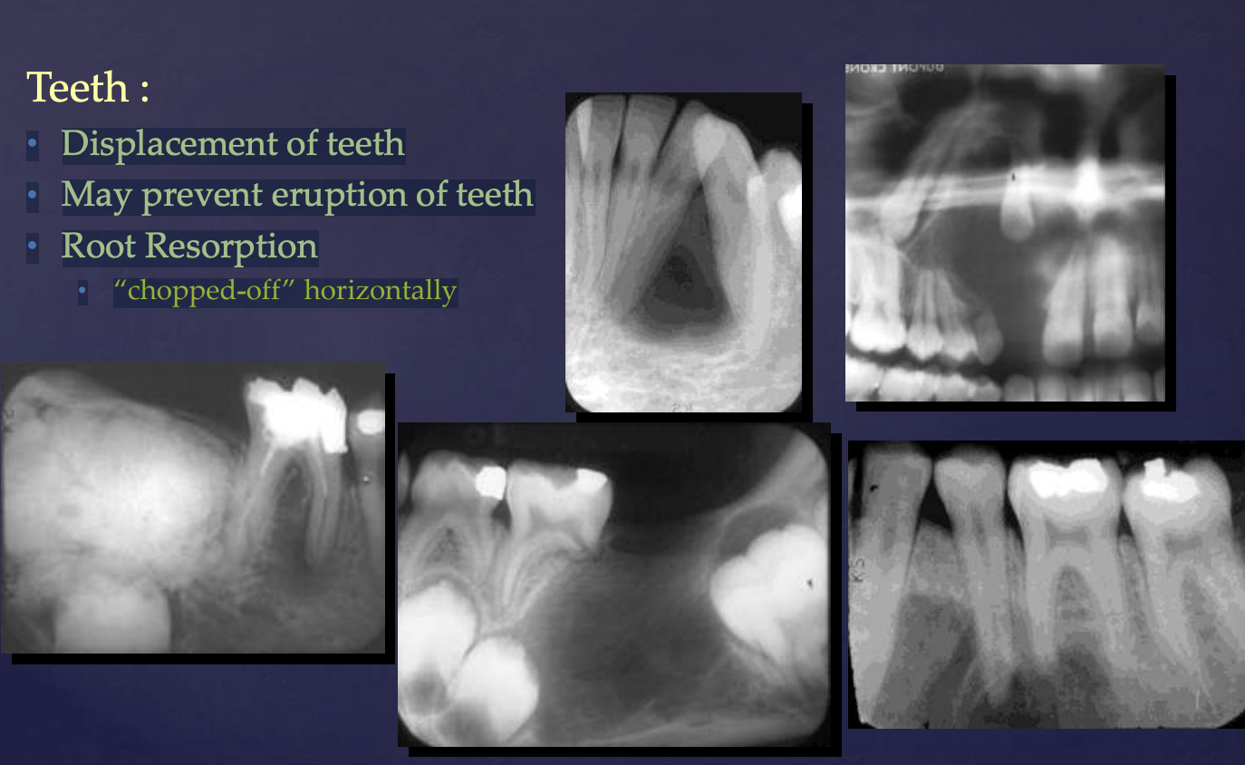 <p>• Displacement of teeth</p><p>• May prevent eruption of teeth</p><p>• Root Resorption → “chopped-off” horizontally</p>