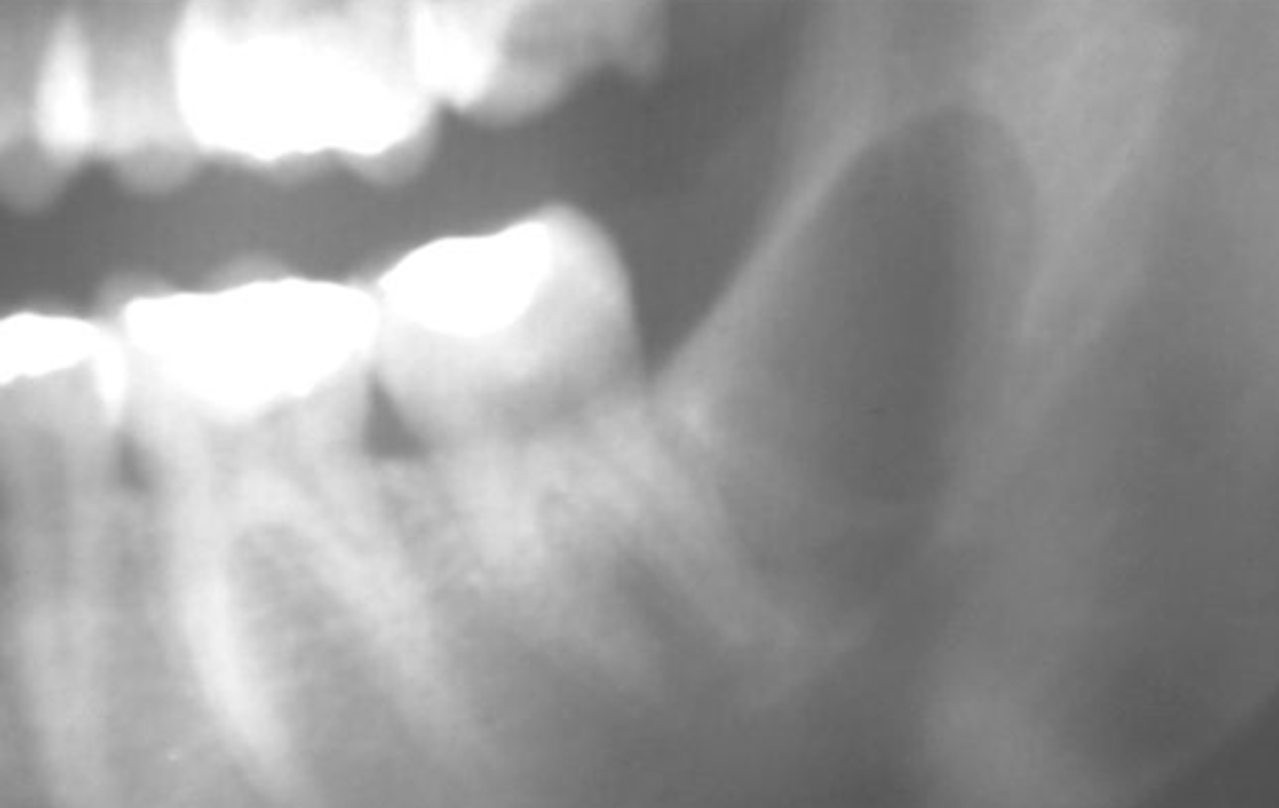 <p>A patient missing one of his third molar since he born. The patient has a cyst that occurs in place of a tooth , unicellular radiolucency</p>