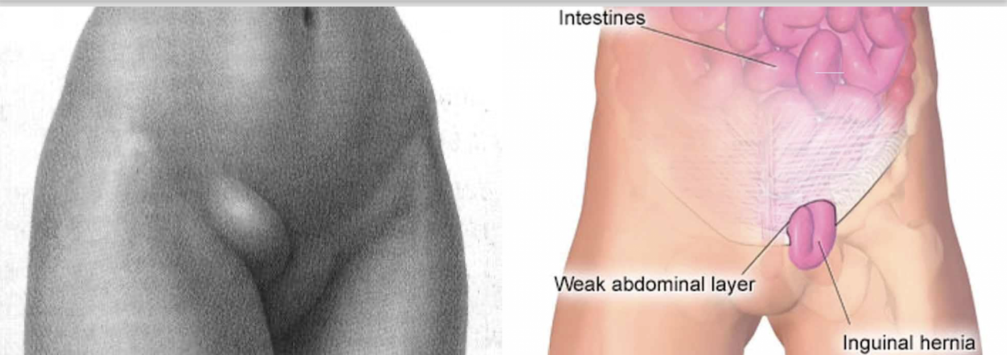 <p>Inguinal Hernia:</p><ul><li><p>What is an Inguinal Hernia?</p></li></ul><p></p><p></p>