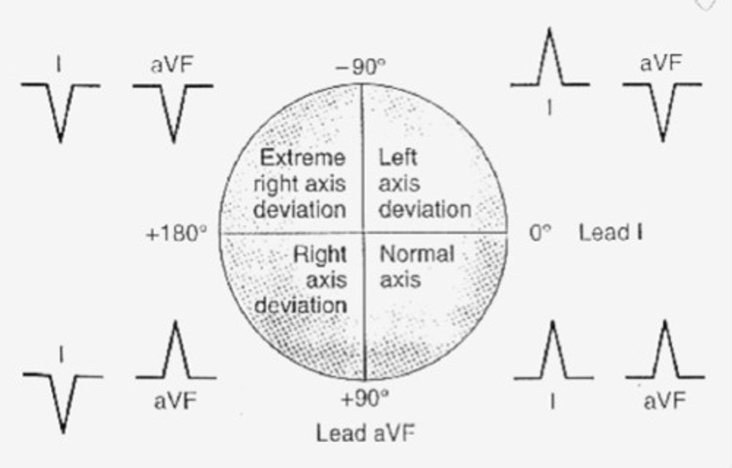 <p>Refers to the direction of movement of depolarization</p><p>- Look in leads I and AVF</p><p>- I-left, AVF-right</p><p>Thumbs:</p><p>- both up = Normal axis</p><p>- both down = Extreme right axis deviation</p><p>- Lup/Rdown = Left axis deviation</p><p>- Rup/Ldown = Right axis deviation</p><p>- Specific axis degrees: determine type of deviation, choose most iso-electric line and go to that line on the circle chart. Go 90 degrees into the good quadrant (the one you know you're in) and that will tell you the exact degrees.</p>
