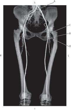<p><mark data-color="purple">Which line is pointing to the lateral circumflex artery?</mark></p>