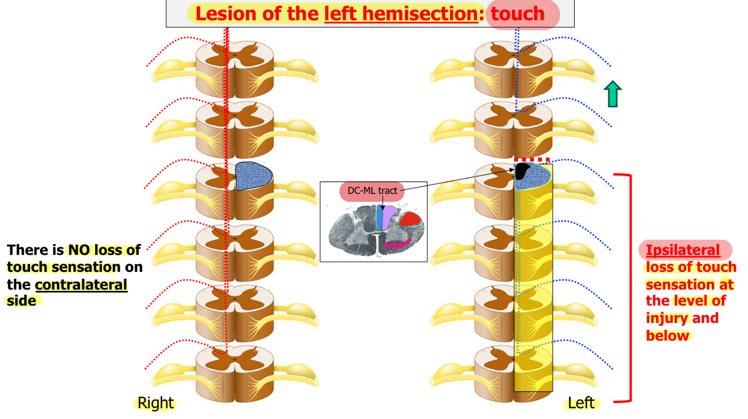 <p><u>Ipsilateral</u> =&gt; loss of touch sensation at the level of injury and below</p><p><u>Contralateral</u> =&gt; NO loss of touch sensation</p>