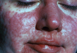 <ol><li><p>light skin - red, flat, and slightly raised</p></li><li><p>dark skin - also flat and slightly raised but purple or darker than surrounding skin</p></li></ol><p></p>