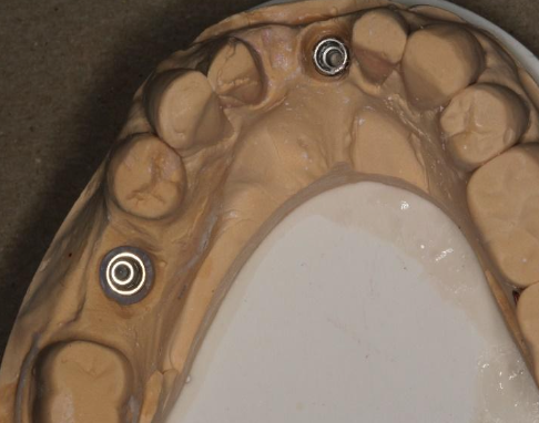 <p>What are your next steps after the lab returns the master cast with full contour wax up?</p>