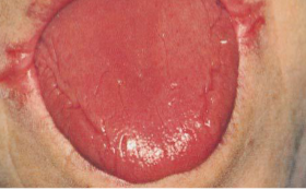 <p>a condition associated with iron deficiency anemia, characterized by dysphagia due to ESOPHAGEAL WEBS, kaoilonychia (spoon like nails), atrophic glossitis</p>