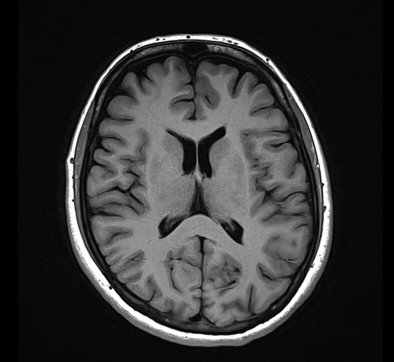 <p>T1 is typically used as an informal anatomy scan.</p><ul><li><p>Fat is Bright (quickly realigns its longitudinal magnetisation with B<sub>0</sub>)</p></li><li><p>Water is Dark (has much slower longitudinal magnetisation realignment after an RF pulse and therefore, has less transverse magnetisation)</p></li></ul><p></p><p><u>Applications</u>:</p><ul><li><p>T1 focuses on highlighting anatomy </p></li><li><p>Useful to detect contrast</p></li><li><p>As contrast media goes to areas of high blood supply it can detect infections</p></li></ul><p></p>