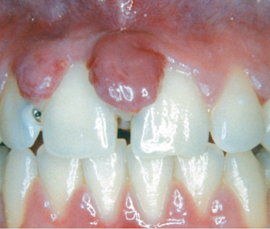 <ul><li><p>Increased hormones = more gingival crevicular fluid flow</p></li><li><p>High inflammation w/ little plaque biofilm</p></li><li><p>Can spontaneously resolve postpartum</p></li><li><p>Pregnancy associated pyogenic granuloma </p></li></ul><p></p>