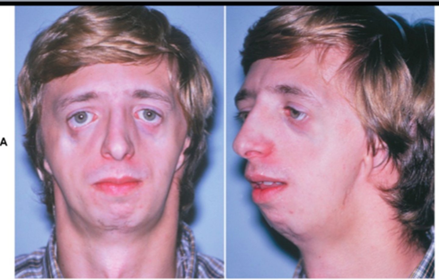 <p>Variety of facial deformities, including lowered eyes, absent cheekbones, cleft palate</p>