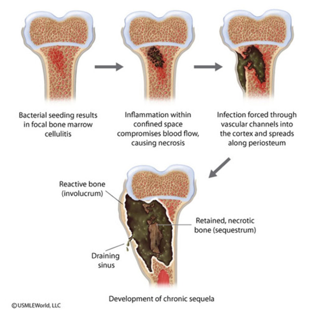 <p>- infection in metaphysis; abscess forms</p>