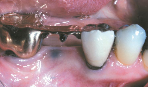 <p>macules or (rarely) as raised lesions which are blue, black, or gray in color,<strong> ill defined </strong></p>