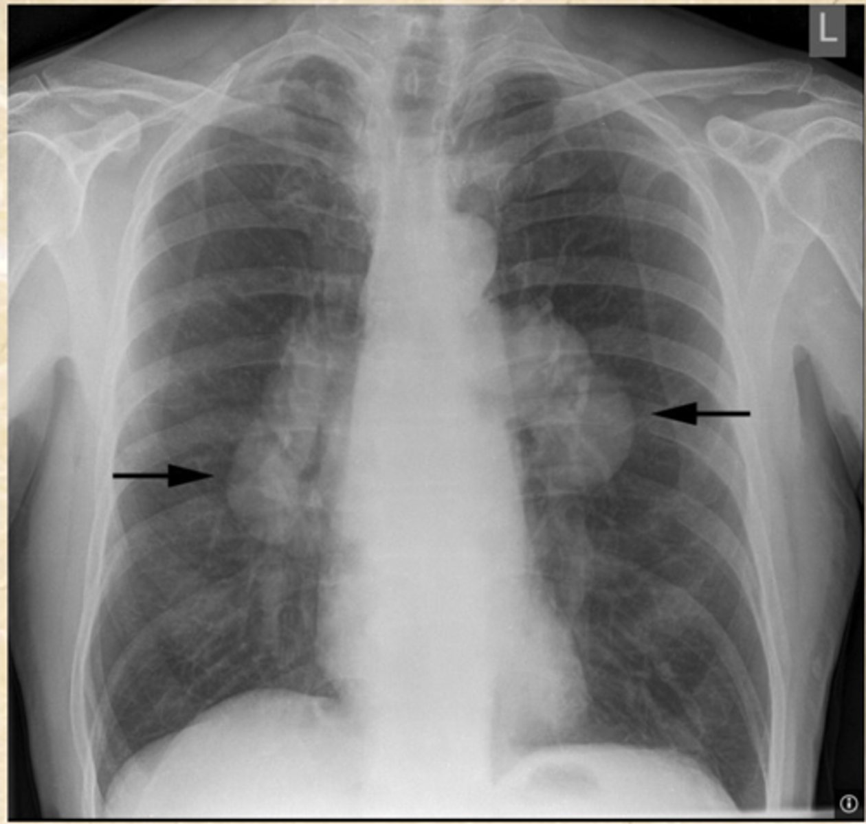 <p>What does this CXR show?</p>