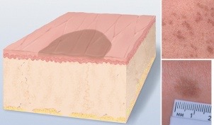 <p>flat, circumscribed, less than 1cm and strictly a color change</p><p>ex: freckle, petechiae</p>