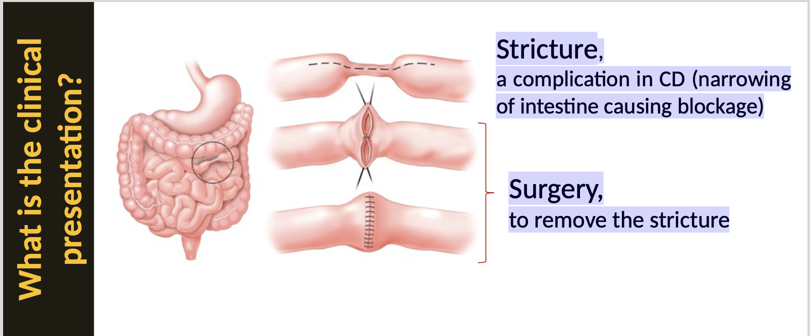 <p>In CD, there is chronic inflammation that can lead to ulceration, <strong>strictures</strong>, and fistulas.</p><p><strong>Stricture</strong>: a complication in CD (narrowing of the intestine causing blockage)</p><p>Surgery to remove the stricture</p>