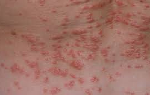 <ul><li><p><strong>Infestation:</strong></p><ul><li><p>Transmitted through skin-to-skin contact.</p></li><li><p>Mites burrow into the epidermis.</p></li><li><p>Presents as papules, pustules, and burrows.</p></li><li><p>Causes intense pruritus (itching).</p></li></ul></li><li><p><strong>Nursing Management:</strong></p><ul><li><p>Apply scabicide lotion as prescribed.</p></li><li><p>Emphasize prevention and environmental control (wash bedding/clothes, vacuum, and treat close contacts to avoid reinfestation.)</p></li></ul></li><li><p><strong>Treatment</strong>:</p><ul><li><p>Step 1:<strong> </strong>Initial Treatment → Kills live mites but not eggs.</p></li><li><p>Step 2: Follow-Up (10–14 days later) → Kills newly hatched mites before they mature.</p><p></p></li></ul></li></ul><p></p>