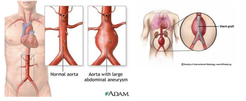 <ul><li><p>A dilation of the aorta — generally tends to occur in infrarenal region (at or below renal arteries)</p></li><li><p>As aorta expands, the risk of rupture increases — generally accepted that when an aneurysm reaches 5.5 cm+ an operation will be significantly beneficial</p></li><li><p>New techniques (other than solder surgical methods) have been developed — ex. endovascular graft —</p><ul><li><p>Surgically dissecting the femoral artery below inguinal ligament, with a small incision made in the femoral artery &amp; preloaded compressed graft with metal support struts passed on a large catheter through femoral artery into abdominal aorta. X-ray is used for guidance to open the graft, lining the inside of the aorta</p></li><li><p>Limb attachments are made to the graft that extend into the common iliac vessels, with this bifurcated tube device effectively excluding the abdominal aortic aneurysm</p></li><li><p>Not suitable for all patients — those with the device don’t need to go to intensive care unit, with many patients leaving hospital in 24-48 hours. Importantly — this device can be used for patients deemed unfit for open surgical repair </p></li></ul></li></ul>