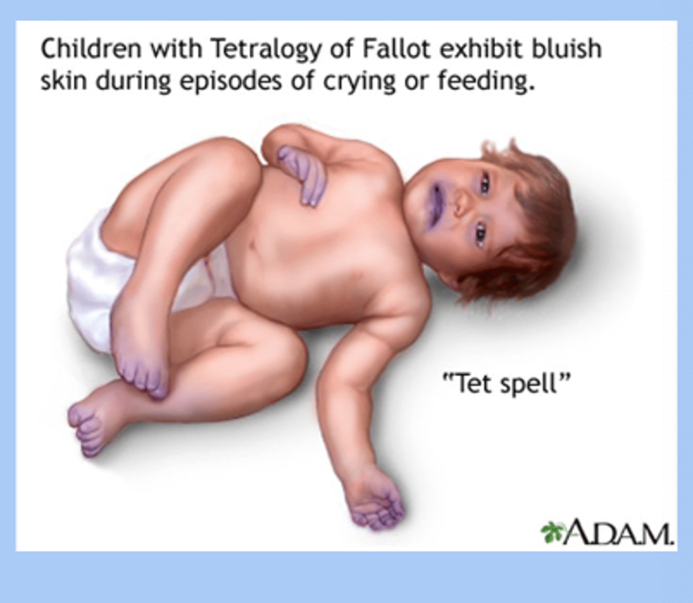 <p>-hypoxemic cyanotic episodes = hallmark </p><p>-sudden onset of cyanosis and child squats downs and sx improve </p>