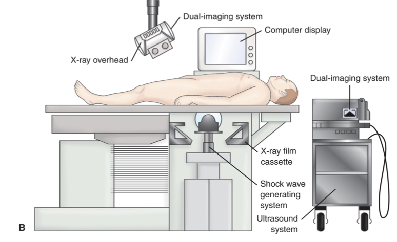 <p></p><ul><li><p>Noninvasis proceedure used to break up sones in the kidney</p></li><li><p>After fragmentation of the stone, remnants are spontaneously voided</p></li><li><p>High energy pressure/shock waves are generated via the abrupt release of energy transmitted through the tissues</p></li><li><p>“The nurse should apply electrodes for continuous monitoring of the client&apos;s cardiac rhythm during ESWL. This monitoring allows the provider to synchronize shock waves with the R wave.” (ATI)</p></li></ul>