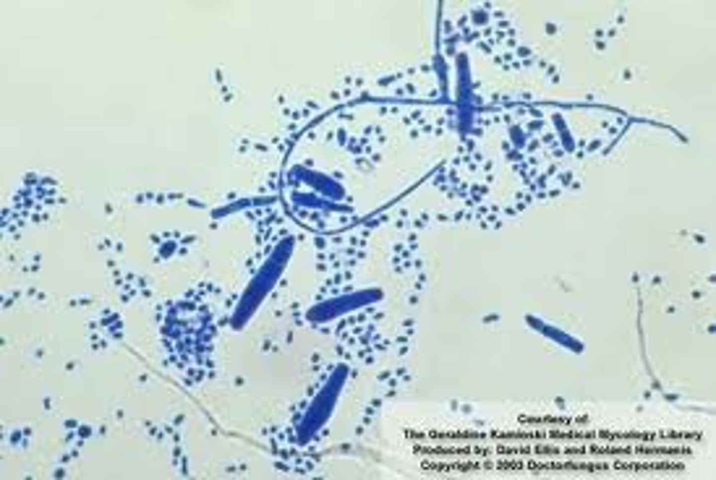 <p>-mainly microconidia arranged singly or in clusters</p><p>-rare macroconidia that are elongated, pencil to cigar shaped, smooth walled, thin walled, multiseptated</p><p>RUBRUM:</p><p>-most frequently isolated dermatophytes causing infection worldwide (ringworm, athlete's foot)</p><p>-fluffy white colonies with reverse side being red (rubrum) being produced when older</p><p>-hyphae are small, septate, hyaline</p><p>-pyriform (tear-drop shaped) microconidia along hyphae (not clustered, look like birds on a wire)</p><p>-macroconidia can be there and are pencil-shaped, multi-cellular, attached to hypae by thick attachements (RARE)</p><p>-TEAR shaped microconidia!!!</p><p>TONSURANS</p><p>-most common cause of SCALP RINGWORM in the US</p><p>-velvet/suede like colonies</p><p>-reverse reddish-brown</p><p>-hyphae are small, septate, and hyaline</p><p>-pleomorphic microconidia usually tear-dropped shape or club shaped, could also be round aka balloon like</p><p>-rubrum is more organized, these tend to cluster more on the hyphae</p><p>-macroconidia are rare</p><p>-could have chlamydoconidia</p><p>SCHOELEINII</p><p>-severe, chronic favus (scarring scalp) infection resulting in permanent hair loos</p><p>-growth often submerged in medium and appear yeast like</p><p>-knobby, irregular hyphae</p><p>-subsurface hyphae from antler-like branches called favic chandeliers with slowell tips like nail heads</p><p>-micro and macro conidia are ABSENT</p>