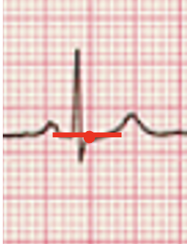 <p>If the J point falls at least ___ _____ ______ (1mm) _____  your line, then you have ST elevation. If not, then you don’t have ST elevation.</p>