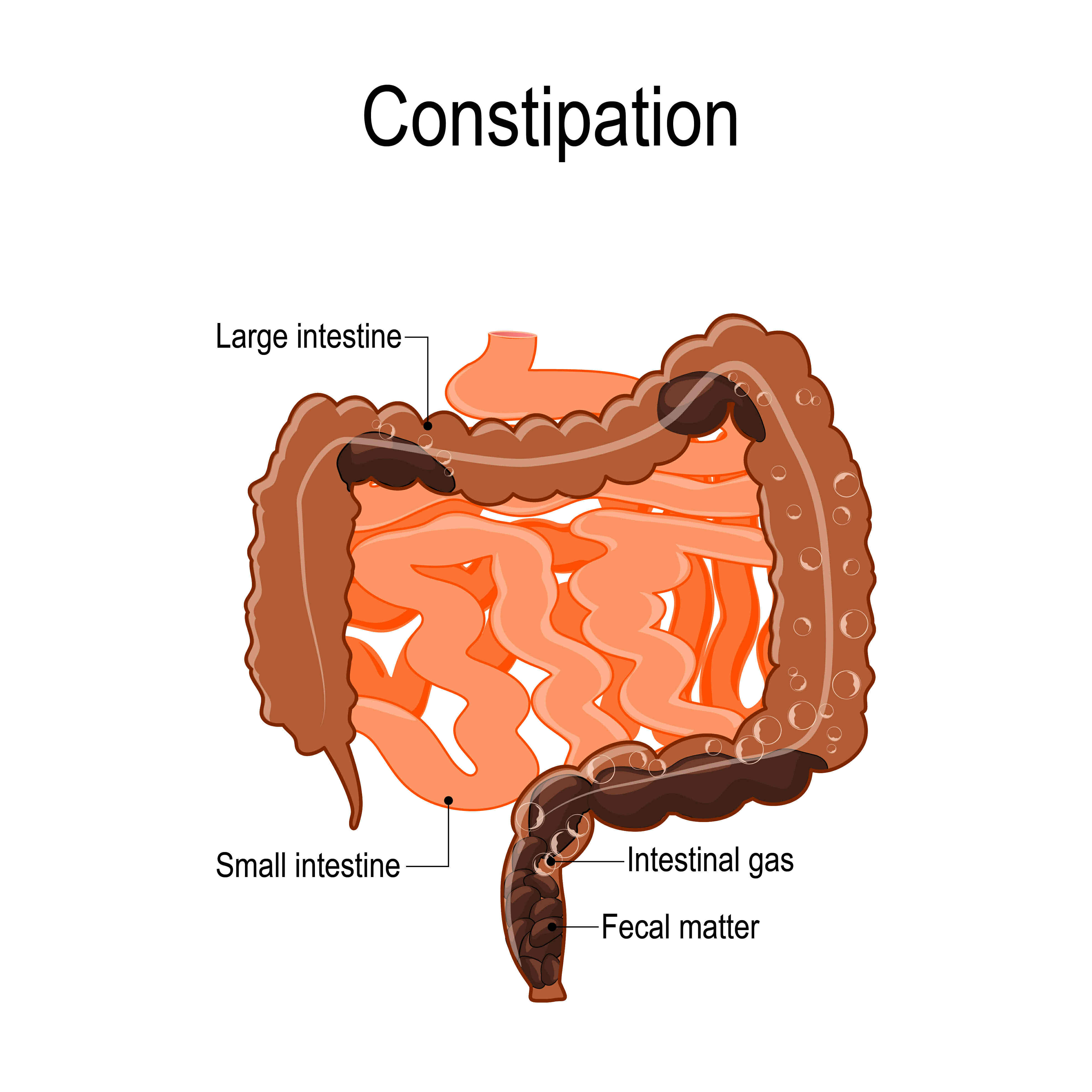 <p>Difficult or delayed defecation caused by low peristalsis movement, by over-absorption of water as its contents sit too long in the intestine, or by dehydration</p>
